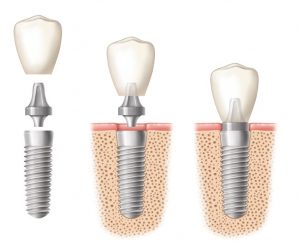 implant dentar clinica dr. vereanu