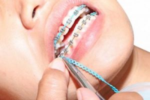 Cele mai noi trend-uri în materie de aparat dentar