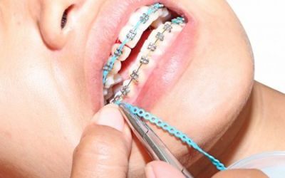 Cele mai noi trend-uri în materie de aparat dentar. Ce preferinţe au româncele